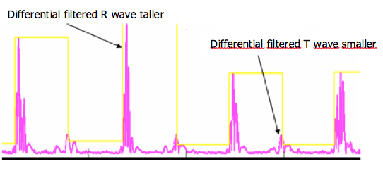 icd_in_20_cs_t_wave_over2.png