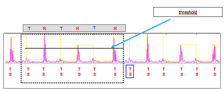 icd_in_20_cs_t_wave_over4.png