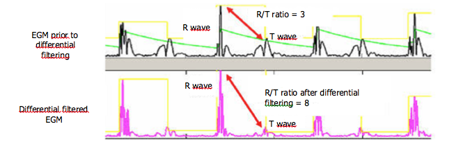 icd_in_20_cs_t_wave_over5.png