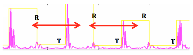 icd_in_20_cs_t_wave_over6.png