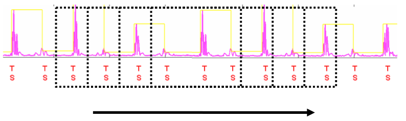 icd_in_20_cs_t_wave_over7.png