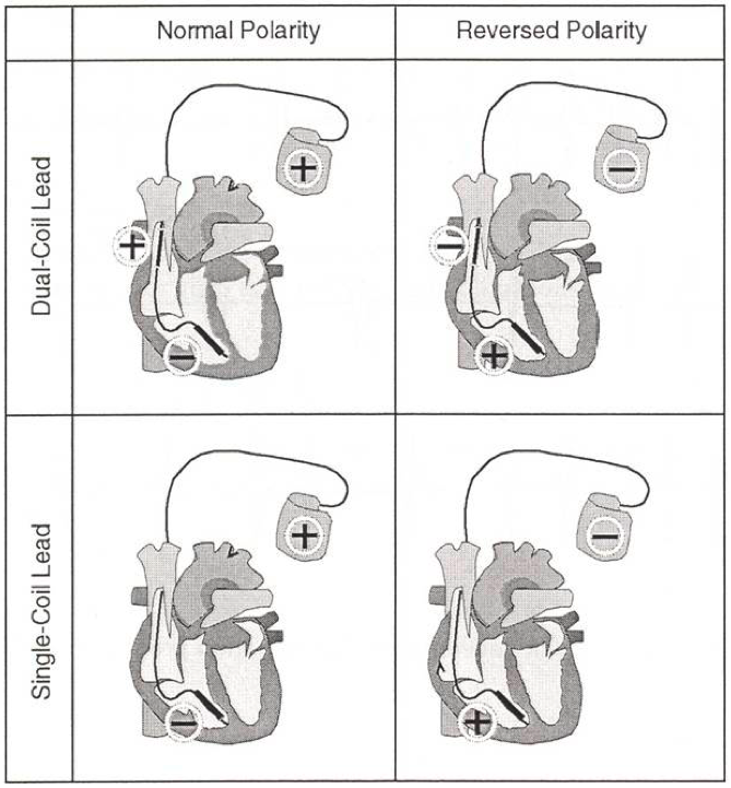 icd_in_20_shocks_in_vf_zone3.png