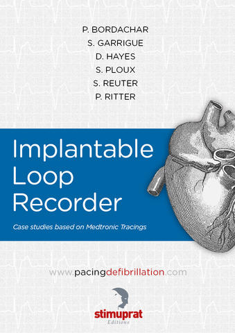Implantable Loop Recorder