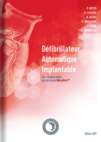 Défibrillateur automatique implantable – Institut de cardiologie