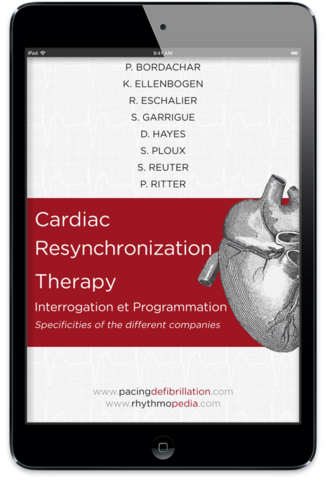 S.E.D.D. Cardiac Resynchronization Therapy ebook