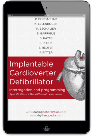 S.E.D.D. Implantable Cardioverter Defibrillator
