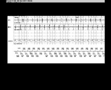 Discrimination double chamber, atrial tachycardia, Onset/Stability 