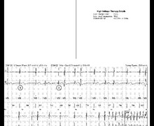 Fibrillation ventriculaire traitée par un choc électrique de moyenne amplitude 