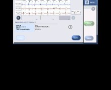 Optimisation du délai AV et du délai VV chez un patient porteur d’un défibrillateur Abbott 