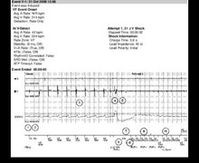 Induction of VF by T-wave shock  