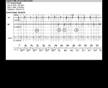 Dual chamber discrimination, sinus tachycardia, Rhythm ID