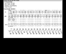 Discrimination double chamber, atrial tachycardia, Onset/Stability 