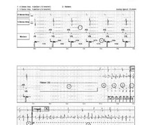 Induction of ventricular fibrillation by direct current