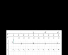 Slow ventricular tachycardia and double counting of the R wave