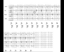 Optimization of the AV delay in a pacemaker non-dependent patient
