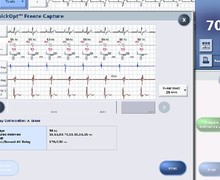 optimization of the AV and VV delays in a recipient of Abbott defibrillator