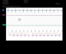 Sinus tachycardia, anti-PMT algorithm and pro-arrhythmogenic effect
