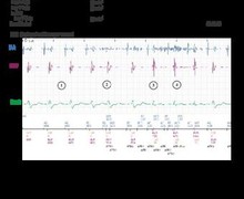 Noise on the atrial channel, inappropriate mode switch and PMT