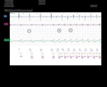 Tachycardia due to electronic re-entry