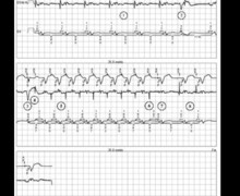 Tachycardie par réentrée électronique sur extrasystole ventriculaire
