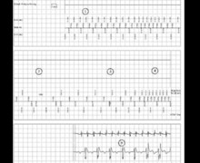 Loss of biventricular pacing due to a prolonged episode of atrial arrhythmias