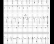Syncope in sick sinus syndrome