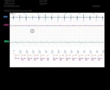 Tachycardie sinusale, algorithme anti-TRE et effet pro-arythmogène