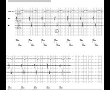 Algorithme Rythmiq et baisse du pourcentage de stimulation ventriculaire