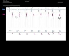 Algorithme Rythmiq et périodes réfractaires ventriculaires post-stimulation atriale