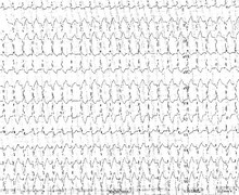 Tachycardie ventriculaire, complexes de capture et de fusion (ECN)