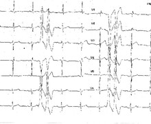 Doublets ventriculaires et dysplasie arythmogène du ventricule droit (ECN)