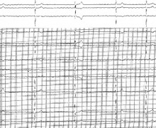 Fibrillation atriale et trouble de conduction atrio-ventriculaire (ECN)
