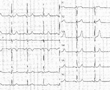Insuffisance aortique et hypertrophie ventriculaire gauche (ECN)