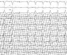 Loss of ventricular capture
