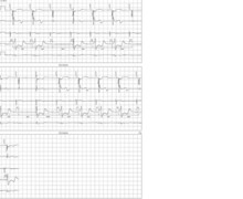 Loss of ventricular capture