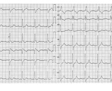 Syncope in a patient with right bundle branch block and left posterior fascicular block