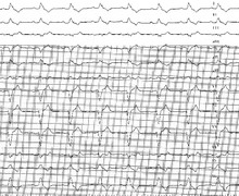 Left bundle branch block and syncope