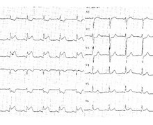 Bloc auriculo-ventriculaire complet sur infarctus du myocarde