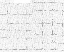 Complete atrioventricular block due to myocardial infarction