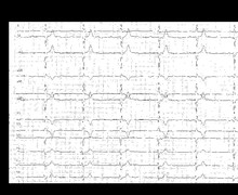 Syncope due to complete atrioventricular block with junctional escape rhythm