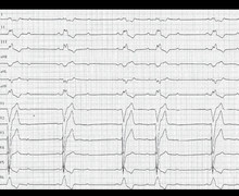 Syncope, left bundle branch block and second-degree atrioventricular block type 1