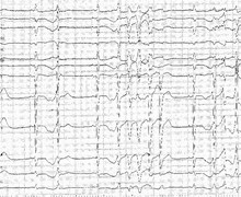 Tachycardie polymorphe et allongement majeur de l'intervalle QT