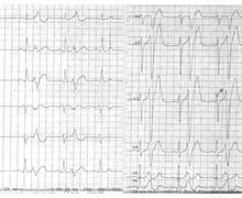 Very early PVC and risk of ventricular fibrillation