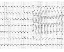 Analysis of the QRS pattern for diagnosing ventricular tachycardia
