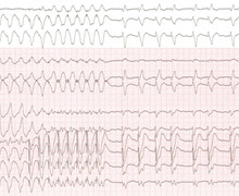 Atrial activity and ventricular tachycardia