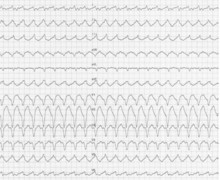 Branch-to-branch ventricular tachycardia due to primary non-ischemic cardiomyopathy