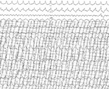 Tachycardie ventriculaire sur dysplasie arythmogène du ventricule droit