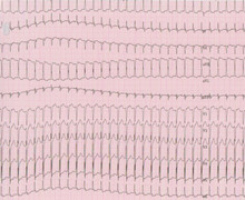 Termination of atrio-ventricular nodal reentrant tachycardia