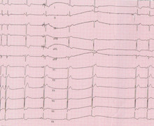 Termination of atrio-ventricular nodal reentrant tachycardia