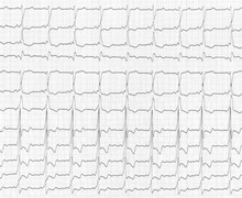 Wolff-Parkinson-White and atrioventricular block